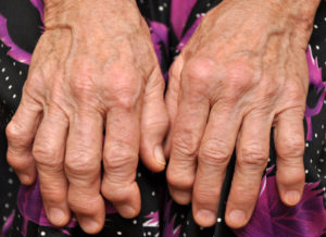 arthritis in hands