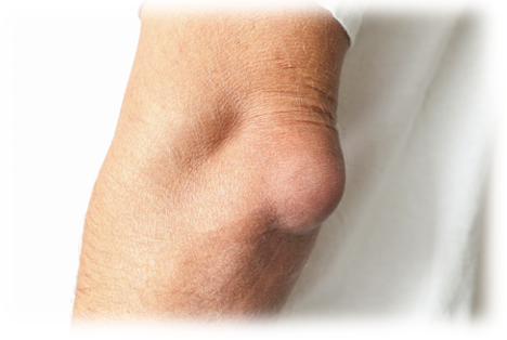 Bursitis of the elbow